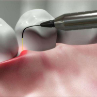 Диодный лазер в стоматологии